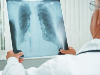 Dzisiejsza medycyna daje szansę nawet na wyleczenie raka płuca.