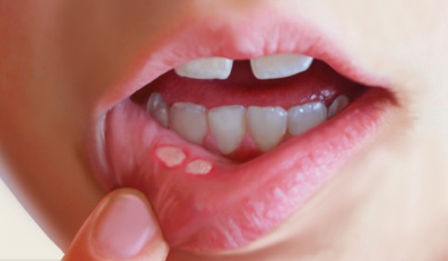 Nawracające afty to problem dla stomatologa